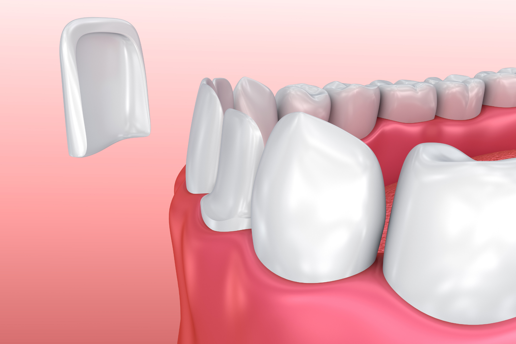 dental veneer rendering