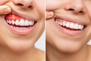 What You Need To Know About Gum Disease And How To Prevent It