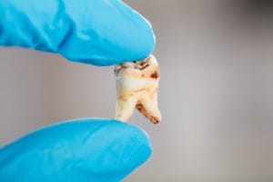 The Importance of Tooth Decay Treatment