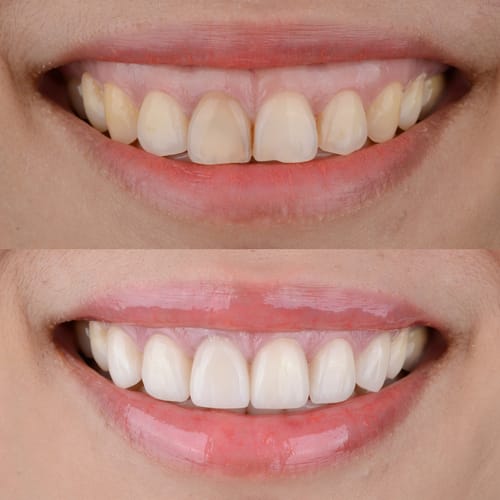 Transform Your Smile: What is a Smile Makeover