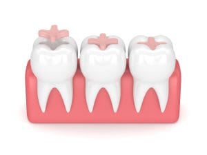 Understanding Dental Inlays and Onlays